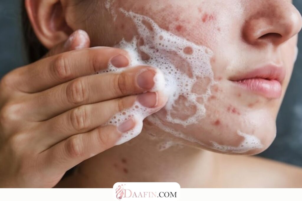 تأثیر ژل شستشوی صورت در کاهش آکنه و جوش